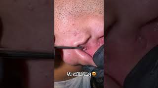 Blackheads in one ear #blackhead #blackheadremoval #blackheads #extraction #extractionsatisfaction