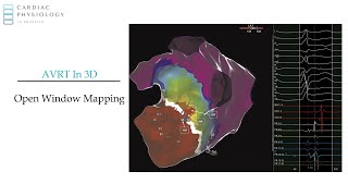 Open Window Mapping for AVRT - EP in Practice sample