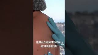 TIK TOK: How To Remove Buffalo Hump (Neck Fat)