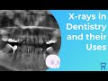 Types of Dental X-rays you NEED to know | Dental Radiographs and Why we use them