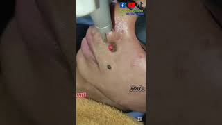 তিল রিমুভ CO2 laser treatment #skincare #co2laser #tattoo #piercing #laser #piercing #laser