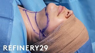 Double Chin Removal Surgery | Macro Beauty | Refinery29