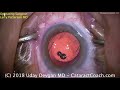 surgical approach for morgagnian cataracts