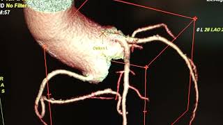 CT coronary ANGIOGRAM: how to perform volumetric rendering and vessel analysis