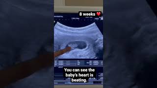 Ultrasound 8 weeks pregnant. The Baby’s heart is beating