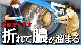 【 急患 】歯が折れたら、膿が溜まったら『 即抜歯 』！？　30分ノーカット 実際の治療の様子　＃膿　＃歯が折れる　＃根管治療　＃根尖病巣　＃歯医者