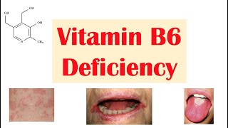 Vitamin B6 (Pyridoxine) Deficiency | Dietary Sources, Causes, Signs \u0026 Symptoms, Diagnosis, Treatment