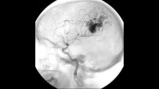 Stereotactic Radiosurgery for Arteriovenous Malformations disclaimer2