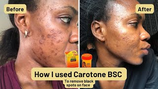 How to get clear skin| Carotone Black Spot Corrector | How I truly got rid of my hyperpigmentation |