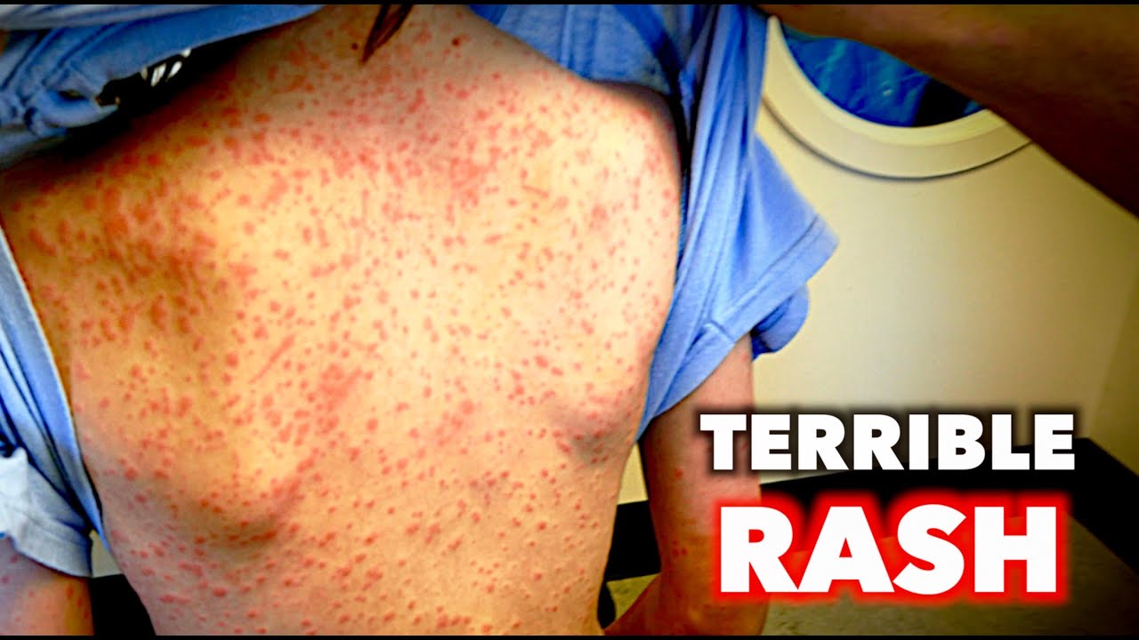 TERRIBLE Full Body Rash | Dr. Paul - YouTube