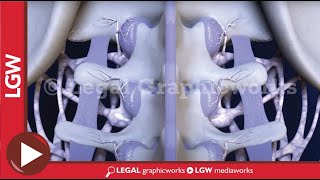 Laminectomy and Laser Assisted Annuloplasty L5 S1 3D Animation