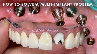 How to solve a Multi-Implant Problem