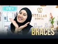 [Braces Review] 