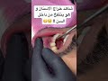 ايه ال بيحصل ل خراج الاسنان لما ننفخه من داخل السن 🫣😬 smiledentist explore smileexpertz