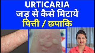 पित्ती ( URTICARIA ) जड़ से कैसे मिटाये | URTICARIA (छपाकि) homeopathic treatment