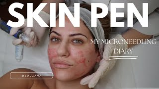 ΠΡΙΝ \u0026 ΜΕΤΑ: SkinPen Microneedling 💁🏻‍♀️