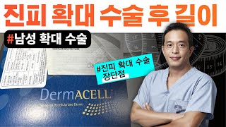 진피를 이용한 남성 확대 수술 후 길이는? - 서울대 전문의