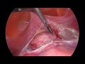 Bladder reflection during laparoscopic hysterectomy