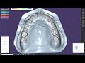 dramatically simplify your screw retained crown u0026 bridge work with exocad u0026 palomalo