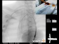 mentice thoracic endovascular aortic repair tevar case video