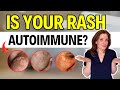 Is Your Rash Autoimmune?