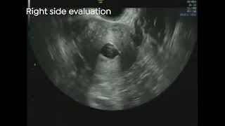 7 FemVue Ultrasound – Bilateral Tubal Occlusion 2