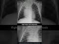 Right Upper Lobe Atelectasis Chest X-ray #shorts