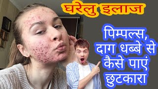 How to get rid of acne | home remedies | 2022 | acne | pimples