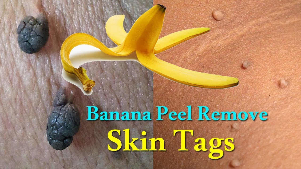 Home Remedies To Remove Skin Tags From Face, 44% OFF