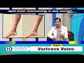 homeocare international varicose veins problem dr.anand namma bengaluru