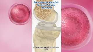 Stem Cell Therapy For Knee Osteoarthritis!