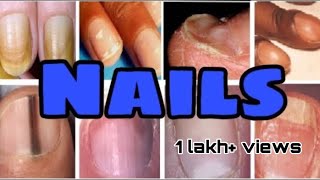 Nails disorders , Nails diseases and differential diagnosis || Mis.Medicine