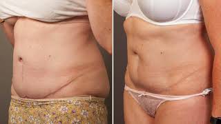 How to reduce scars after abdominoplasty surgery