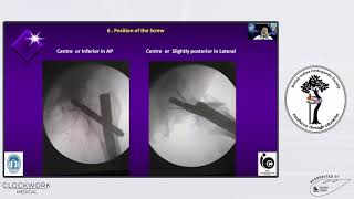 Top Tips in Nailing for Femur - Dr. B Shivashankar