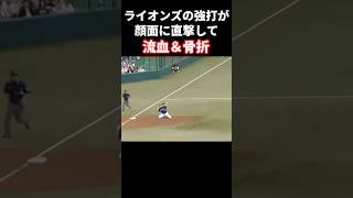 強打が顔面に直撃して流血＆骨折 #プロ野球