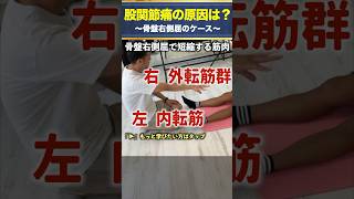 【股関節痛】骨盤が右側屈の時どの筋肉にアプローチしたらよいの？？ #姿勢評価 #治療家 #骨盤調整