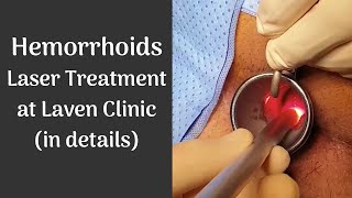 Hemorrhoids - New Laser Treatment using local anesthesia at Laven Clinic Group (in details)