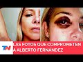 Tras la denuncia a Alberto Fernández, se conocieron las fotos de Fabiola Yañez golpeada