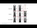 alignment of the knee with the cpak classification