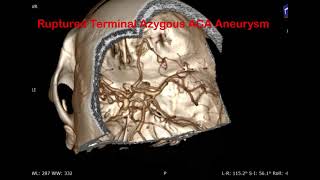 Azygous ACA  (Anterior Cerebral artery) Aneurysm microsurgical clipping| DACA aneurysm