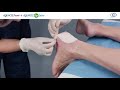 AQUACEL® Foam Application - Heel Pressure Ulcer