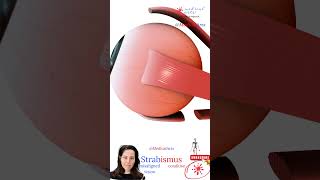 Crossed Eyes Repair 👁️ Strabismus 😏 hypertropia ⚕️ Medical Arts Animation