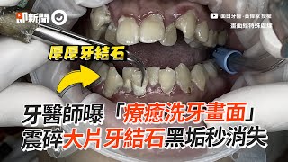 牙醫師曝「療癒洗牙過程」　沖起大片牙結石、黑垢秒消失｜牙齒保健｜口腔衛生｜口腔清潔