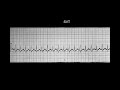 ekg itu gampang sesi 5 latihan aritmia level pemula