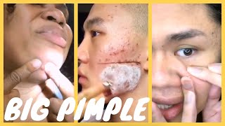 Amazing Popping huge blackheads and BEST Pimple Popping - TIKTOK Videos Compilation #2