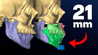 1 Year After Extreme Jaw Surgery. Was It Worth It?