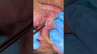 black heads extraction - satisfaction video