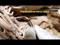 BRACHIAL PLEXUS M-Landmark Cords Branches and Clinical Aspects – Sanjoy Sanyal