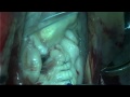 mitral valve repair p2 prolapse triangular excision