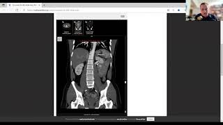 Vascular Anomalies: IVC